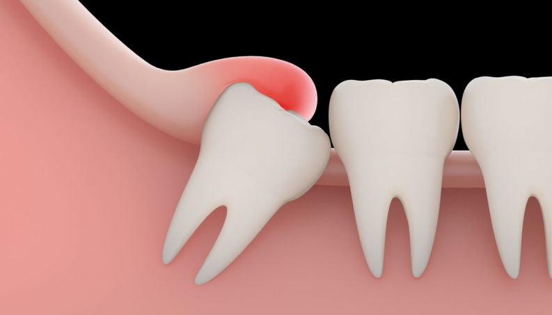 E esse dente siso aí? Vamos extrair?