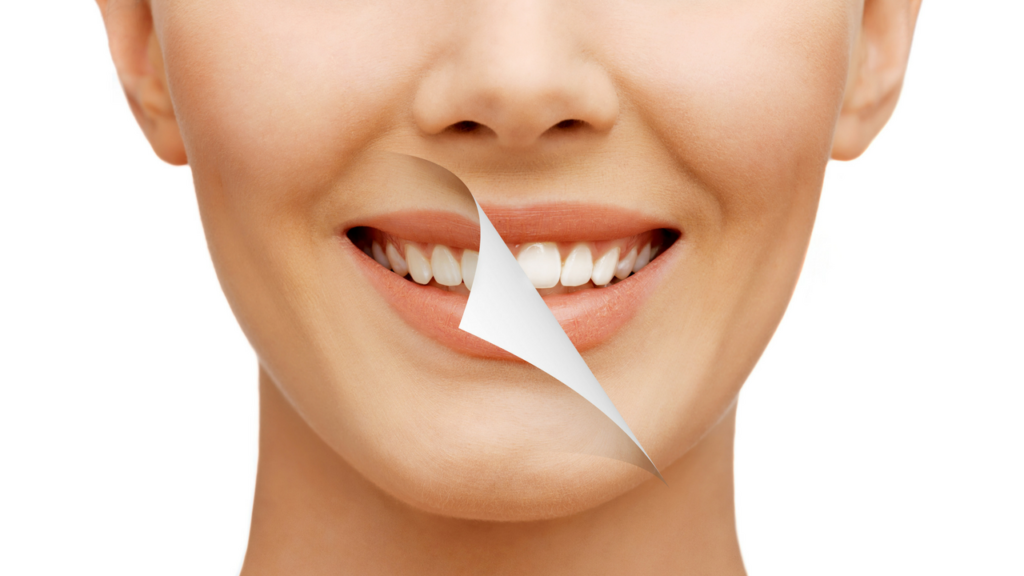 Na CWB não tem BLACK FRIDAY, tem WHITE SMILE! Clareamento dentário
