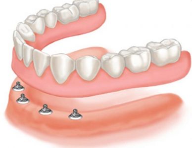 prótese overdenture