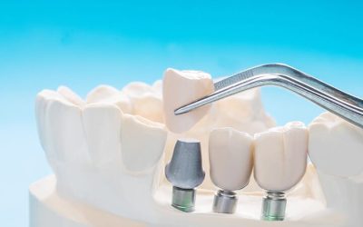 Próteses x Implantes Dentários: Escolhendo a Melhor Opção para Restauração Odontológica